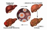 乙肝转阴真实案例揭秘：抖音热门视频分享治疗经历与心得