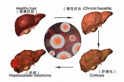 乙肝转阴真实案例揭秘：抖音热门视频分享治疗经历与心得